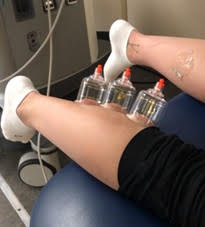 Picture of three cups applied to a human's calf to study the effect of cupping