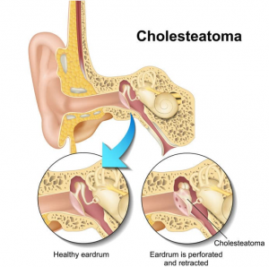 diagram of cholesteatoma in healthy eardrum and one that is perforated and retracted