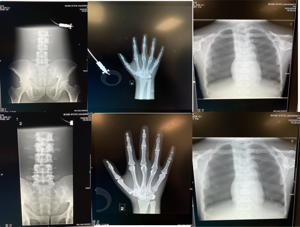 Radiographs for lumbar, hand, and chest phantom