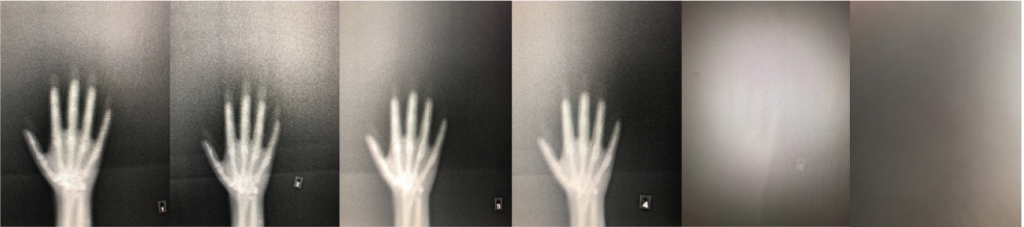 series of six scans with phantom hand; first is very clear and visibility gets less clear with the last image unrecognizable