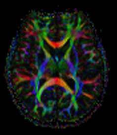 MRI images of the cerebrum