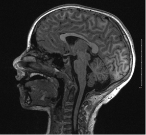 MRI image of child's brain
