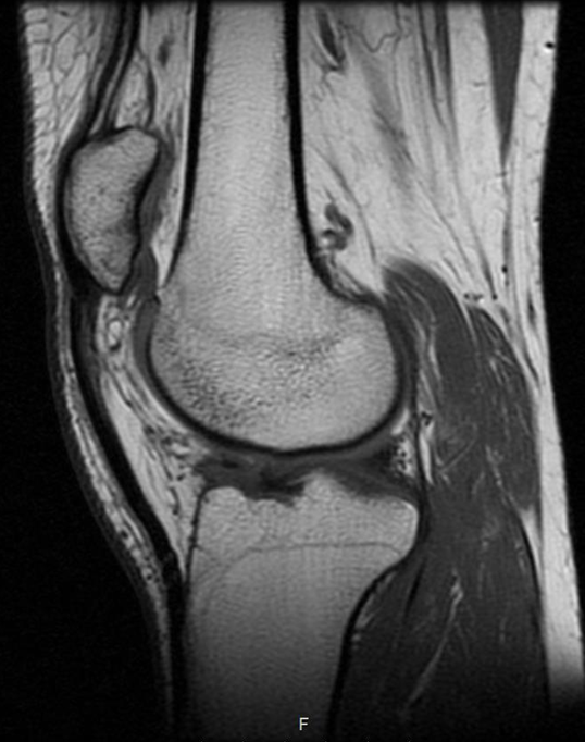 MRI of Knee